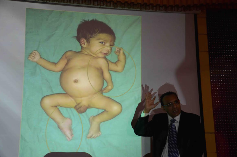 Dr. Prabhakar describes the case of a child with 3 hands